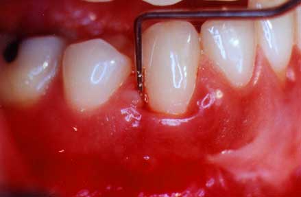 periodontal probe in pocket